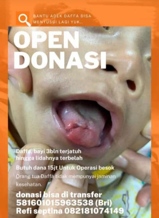 Daffa Bayi Mungil Usia 3 Bulan Alami Robek Lidah, Butuh Uluran Tangan Dermawan 